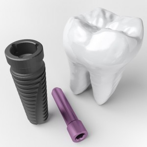 dental implant d