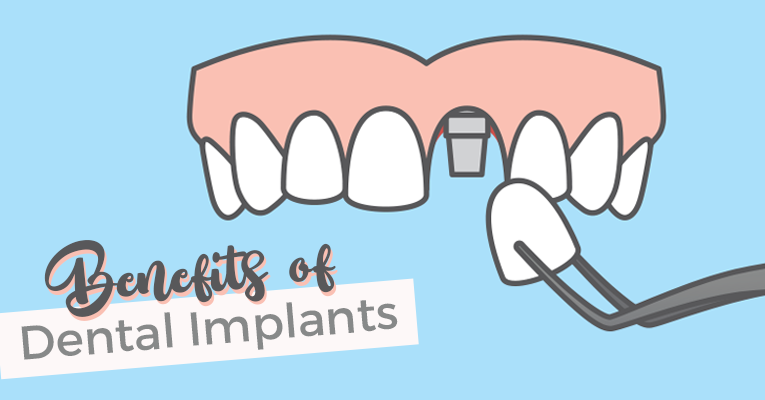 dental implants