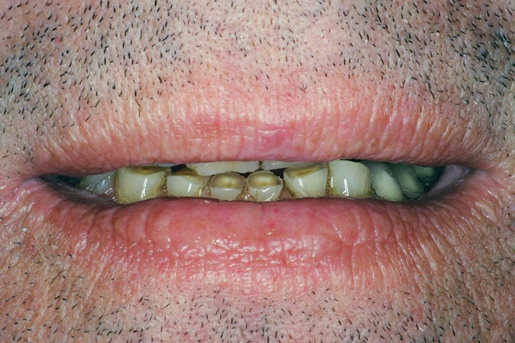 This patient was embarrassed by his teeth and would barely smile.