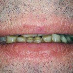 This patient was embarrassed by his teeth and would barely smile.