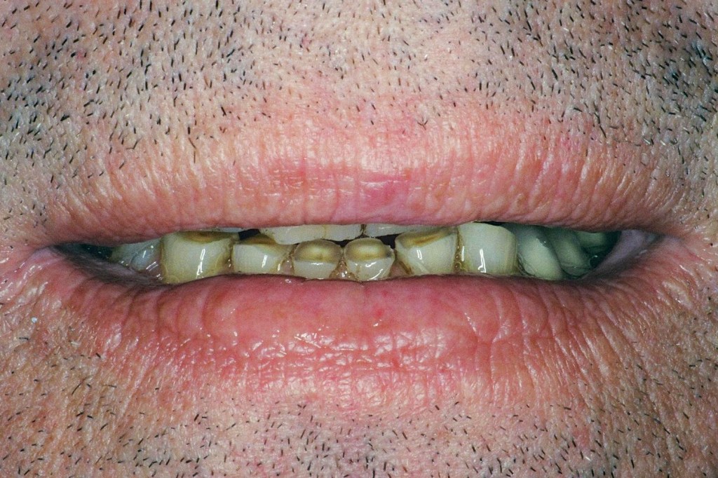 This patient was embarrassed by his teeth and would barely smile.