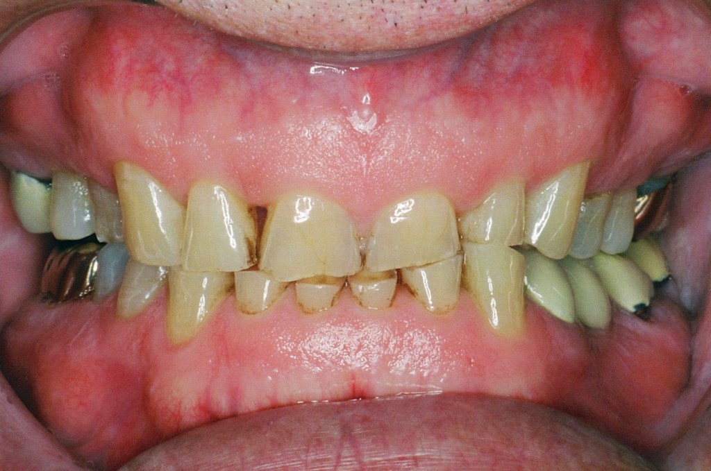 His teeth were severely worn from bruxing and clenching.