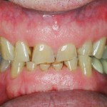 His teeth were severely worn from bruxing and clenching.