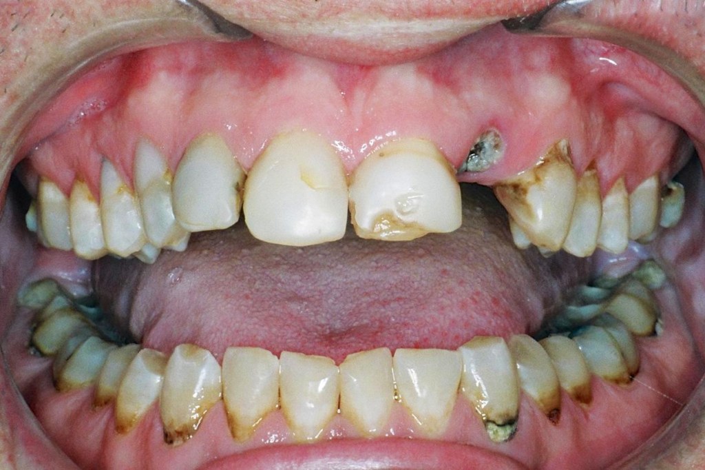 Other dental problems aside, the job required him to immediately smile more confidently.