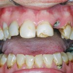 Other dental problems aside, the job required him to immediately smile more confidently.