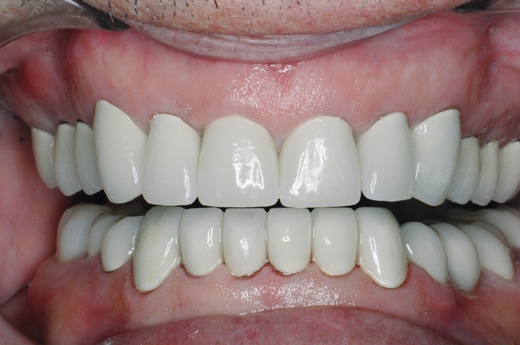 After a few months fine-tuning his new bite, permanent crowns were made to fit the corrected bite relation.