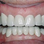 After a few months fine-tuning his new bite, permanent crowns were made to fit the corrected bite relation.
