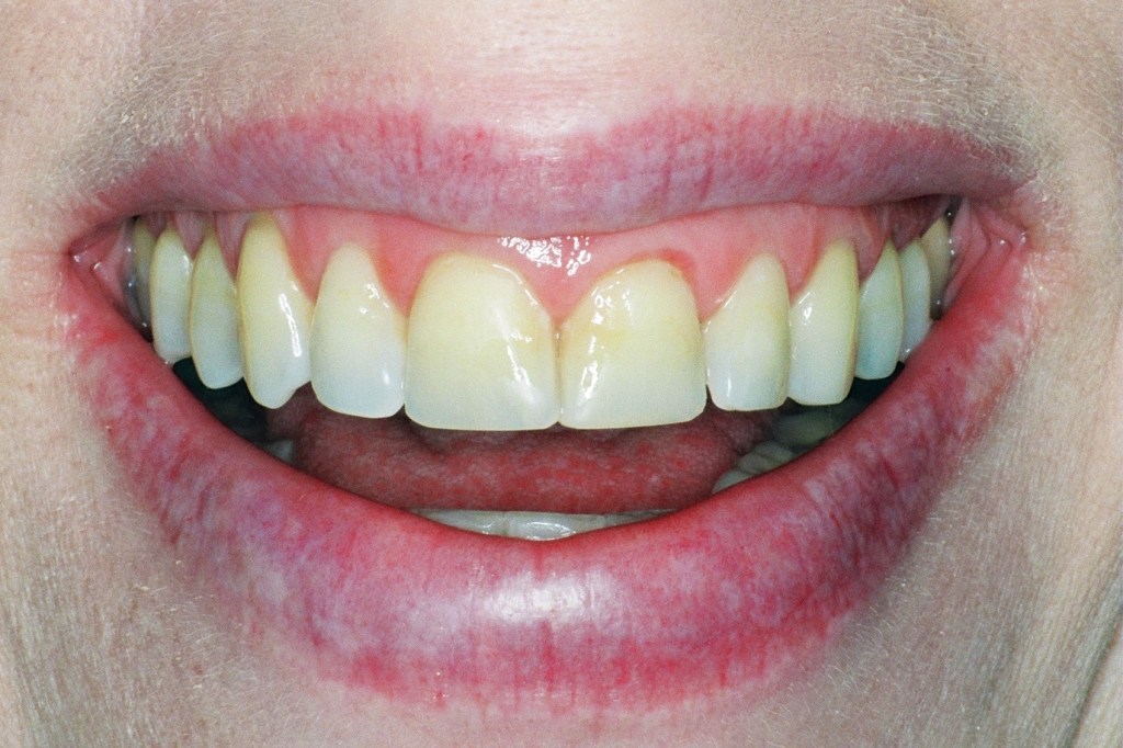 This patient complained of a gummy smile.