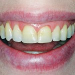This patient complained of a gummy smile.