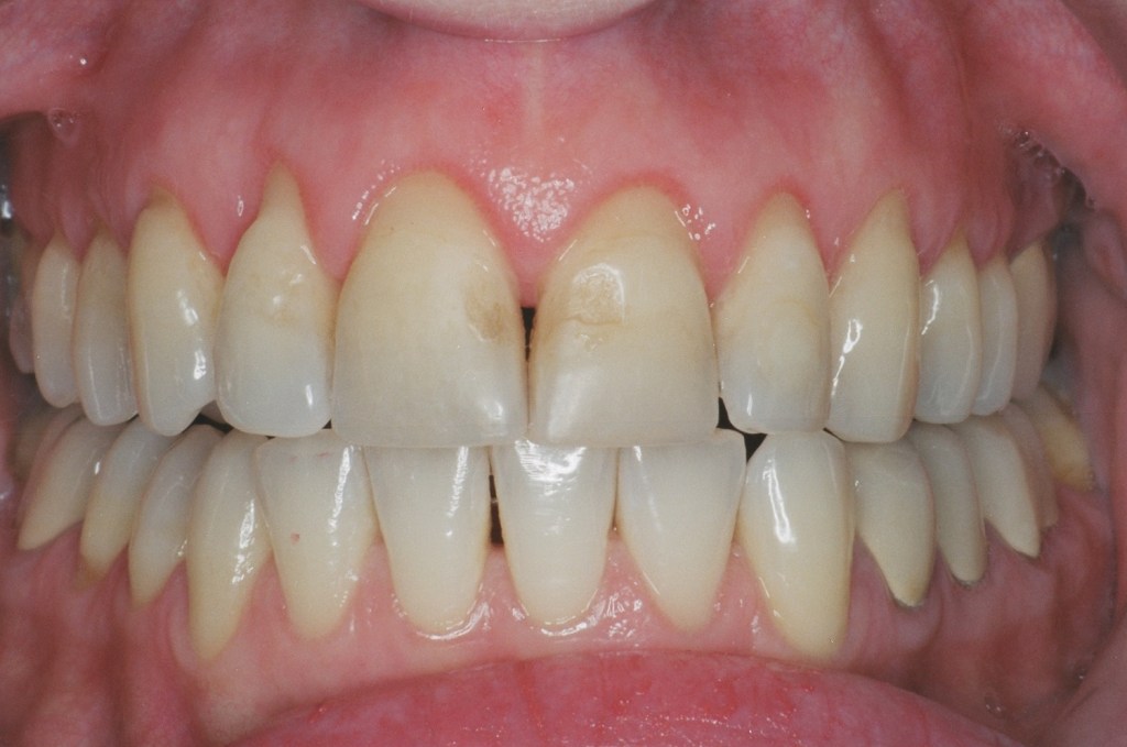 It took time, but clinical crown lengthening established the proper gum line to lip line.