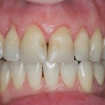 It took time, but clinical crown lengthening established the proper gum line to lip line.