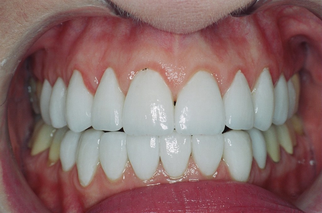 Porcelain veneers were crafted to create a more proportionate, and whiter, smile.