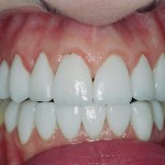 Porcelain veneers were crafted to create a more proportionate, and whiter, smile.