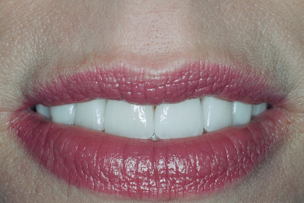 Now this patient says she gets compliments on her smile!