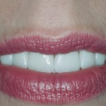 Now this patient says she gets compliments on her smile!