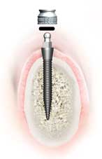 Mini titanium alloy dental implants, rooted into the jawbone