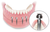 Mini Implants in use