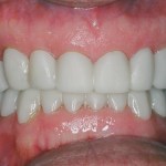 These are not temporaries. In one visit, functional buildups were placed to develop the correct bite relationship.