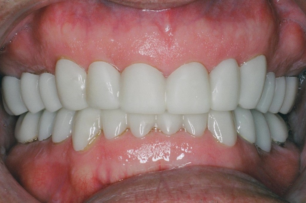 These are not temporaries. In one visit, functional buildups were placed to develop the correct bite relationship.